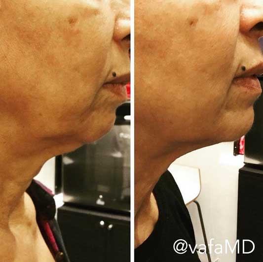 double chin treatment mendham Larchmont before after photos